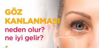 Goz Kanlanmasi Neden Olur Ne Iyi Gelir