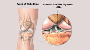 The athlete is usually unable to bear weight on the limb. Ayurvedic Treatment Of Anterior Cruciate Ligament Injury