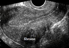 The condition is typically found in women in the ages between 35 and 50. L Echographie Pelvienne