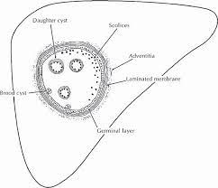Class i and v are suggestive of hydatid cysts in endemic areas. Hydatid Cysts Of The Liver Diagnosis Complications And Treatment Intechopen