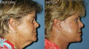 Say Goodbye To Your Turkey Neck This Thanksgiving Dr Shapiro Aesthetic Plastic Surgery Skin Klinic