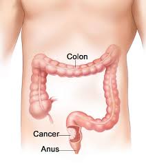 The colon removes water, salt, and some nutrients forming stool. Colorectal Cancer Treatment In Chennai Cancer Removal Surgery India