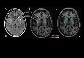 Gene Therapy For Parkinson S Disease Yields Promising Results In First Patients Imperial News Imperial College London