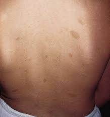 1) neurofibromatosis type 1 or nf1 affects 1 in 3500 people worldwide and is caused by a mutation in the neurofibromin gene, 2. Neurofibromatosis Children S Health Issues Msd Manual Consumer Version