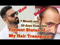 Have you ever found any person in this world who will not worry about his/her hair? Best Hair Transplant In India 2018 My Present Hair Transplant Condition Youtube