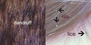 Image result for lice vs nits