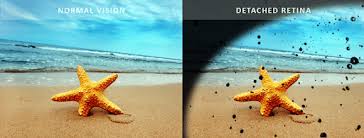 Image result for Retinal Detachment