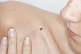 We did not find results for: Can Home Remedies Get Rid Of Moles 14 Ways