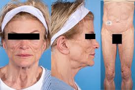 Marked Hypoleptinemia Precedes Overt Fat Loss in Immune Checkpoint  Inhibitor-induced Acquired Generalized Lipodystrophy