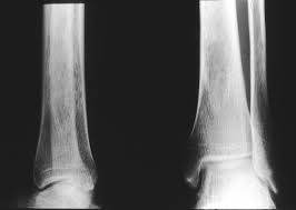 If vitamin d did nothing more than protect bones, it would still that means in most of europe and everywhere in the us that is north of phoenix/atlanta, people probably need to supplement their vitamin d intake. Calcium Plus Vitamin D Supplementation May Not Have Joint Benefits