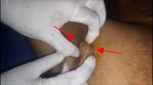 How do you know you have ingrown armpit hair? Painful Ingrown Hair Underarm Cyst With Black Pus Removed Youtube
