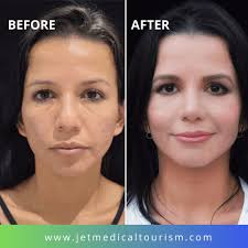 How much does a nose job cost in texas. Is It Safe To Get A Nose Job In Mexico Jet Medical Tourism In Mexico