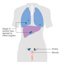 Can patients with relapsed, pre viously untreated, stage i epithelial ovarian cancer be successfully treated with salvage. File Diagram Showing Stage 4 Ovarian Cancer Cruk 233 Svg Wikipedia