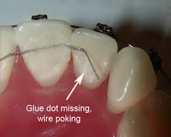 How to cut braces wire with nail clipper. Treatment Support