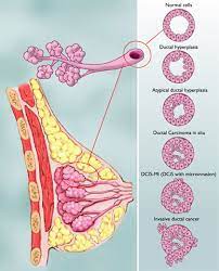 Its symptoms are different from those of other breast cancers. Diagnosis Of Dcis