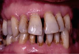 Diabetes Mellitus Dental Implants And Periodontal Disease Sciencedirect