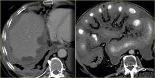 We still need to carry out more investigations such as radiograhy and electrocardiography to ascertain our diagnosis. The Radiology Assistant Peritoneal Pathology