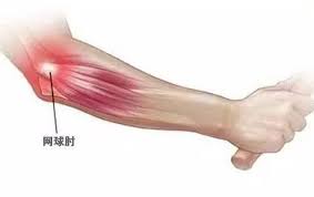 網球肘 ( 網球手 ) tennis elbow 王嘉暉醫生(骨科專科醫生) 這是手肘外側肌腱發炎的痛症，當然不單止會發生在網球員身上。發 炎是由負責手指及手腕伸展的肌肉，被重覆用力過勞性運用而造成。 這種過勞性運用，令肌肉連接骨骼的部位（即手肘外側），出現細微 é'ˆå¯¹ç½'çƒè‚˜è¶…çº§æœ‰æ•ˆçš„10ä¸ªç»ƒä¹ åŠ¨ä½œ çŸ¥ä¹Ž