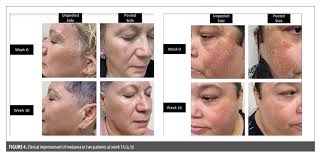 Image result for Melasma calycinum
