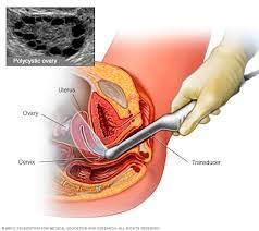 Maybe you would like to learn more about one of these? Ù… ØªÙ„Ø§Ø² Ù…Ø© Ø§Ù„Ù… Ø¨ÙŠ Ø¶ Ù… ØªØ¹Ø¯ Ø¯ Ø§Ù„ØªÙƒÙŠ Ø³Ø§Øª Pcos Ø§Ù„ØªØ´Ø®ÙŠØµ ÙˆØ§Ù„Ø¹Ù„Ø§Ø¬ Mayo Clinic Ù…Ø§ÙŠÙˆ ÙƒÙ„ÙŠÙ†Ùƒ