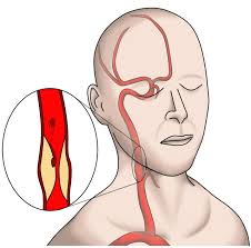 Image result for carotid artery