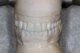 Townie Treatment Case: Can'T Be Tamed By Dr. Adith Venugopal - Orthotown