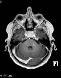 Die erkrankung geht mit charakteristischen. Chronic Lymphocytic Inflammation With Pontine Perivascular Enhancement Responsive To Steroids Clippers Radiology Reference Article Radiopaedia Org