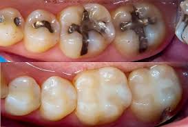 Gaggers are fun to work on. How To Get Rid Of Cavities The Easy Way Doctor Sutera Explains