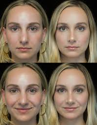 The Complete Guide To Rhinoplasty Rhinoplasty Before And After Rhinoplasty Nose Jobs Rhinoplasty Surgery