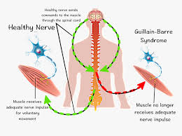 Gbs happens because your immune system attacks nerve cells by mistake. Exercise Guillain Barre Syndrome Hd Png Download Transparent Png Image Pngitem