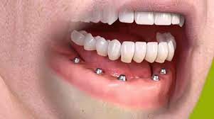 Nobel biocare offers an extensive assortment of dental implants for all indications, bone types and surgical protocols, to satisfy every user experience level and selected treatment concept. Dental Implants Teeth Implants By Mydentist