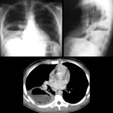 Image result for Lung Abscess