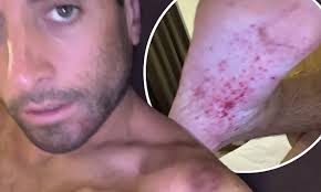 James Argent shows off his shocking injuries from SAS: Who Dares Wins