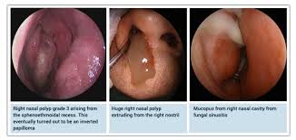 Image result for Sinus Surgery