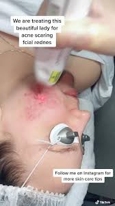 Laser hair removal surrounding mississauga on: Facial Laser Hair Removal Mississauga Ontario Best Laser Treatment For Face Facial Laser Hair Removal Skin Tightening Laser We Are Authorized Artofit