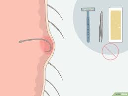 Ingrown hairs may be caused by ingrown hairs most characteristically involve areas that are shaved, like the beard, bikini area, and legs. Pin On Ingrown Hair