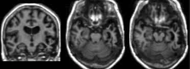 Dementia with lewy bodies, lbd, lewy body disease, parkinson's disease dementia. Diagnostic Imaging Of Dementia With Lewy Bodies Frontotemporal Lobar Degeneration And Normal Pressure Hydrocephalus Springerlink