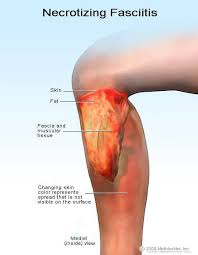 It's also known as wound vac. Necrotizing Fasciitis Treatment Symptoms Pictures Diagnosis Causes Of Flesh Eating Disease