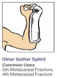 Image result for Ulnar Gutter Splint