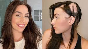 Dr leona yip, research fellow, st vincent's hospital, melbourne, australia, 2007. Robyn Germyn Influencer S Candid Message About Alopecia Aereata Goes Viral