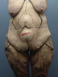 Check out results for pictures tummy tuck Fleur De Lis Abdominoplasty Including Mons Contouring Plastic Surgery Key
