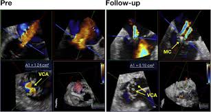 Puls 24 apk content rating is rated for 3+ and can be downloaded and installed on android devices supporting 24 api and above. Recurrence Of Functional Versus Organic Mitral Regurgitation After Transcatheter Mitral Valve Repair Implications From Three Dimensional Echocardiographic Analysis Of Mitral Valve Geometry And Left Ventricular Dilation For A Point Of No Return