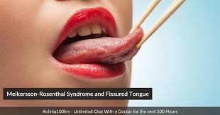 Image result for Fissured tongue