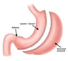 Pin On Bariatric Surgery Information