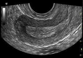 The condition may cause chronic pain, such as a constant dull ache, which can be worsened by standing or sex. Pelvic Ultrasound Radiology Reference Article Radiopaedia Org