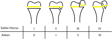 We would like to show you a description here but the site won't allow us. Epiphysiolyse Wikipedia