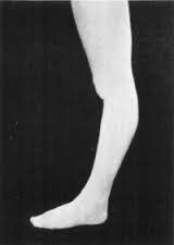 This may result to a strain or a tear in the ligament. A Few Approaches To A Hyperextended Knee In Asana Home Yoga Practice