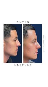 Les comparto el resultado de una rinoplastia 15 días después de la cirugía.  🙌✨ , Aún en proceso de recuperación, ya se pueden apreciar los cambios  iniciales, con una nariz más estilizada y en armonía ...