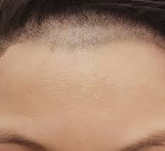 Laser hair removal is a common treatment that permanently reduces the growth of unwanted hair. Laser Hair Removal Clinic Melbourne Cbd Laser Hair Removal Costs