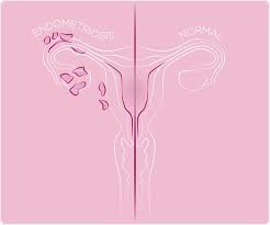 Journal of assisted reproduction and genetics. Missed Or Delayed Diagnosis Of Endometriosis